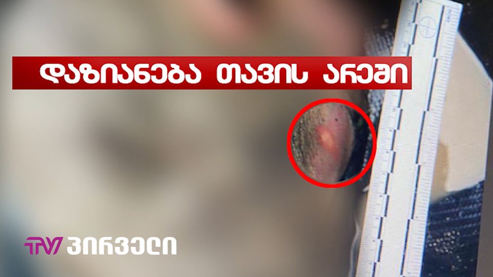 (ვიდეო) ათეულობით ფოტომასალა - მოტეხილი ხელი, დაზიანება თავის და წელის არეში...