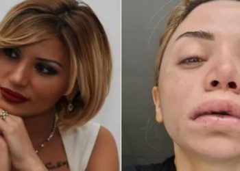 “მომატყუეს, ფილერის მაგივრად, ბიოპოლიმერი შემიყვანეს… ისე გამირთულდა, ტუჩის ქვეშ, ფაქტობრივად, ახალი ტუჩი ამომდიოდა” – როგორ იქცა ეკა ყუშიტაშვილი ესთეტიკური ცენტრების მსხვერპლად