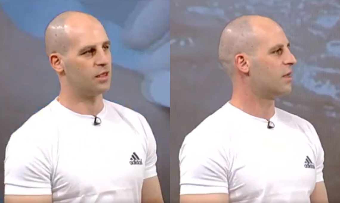 🎥 რა შემთხვევაშია უსაფრთხო ლაზერული ეპილაცია და არსებობს თუ არა ასაკობრივი შეზღუდვა – ზაზა თელიას რჩევები