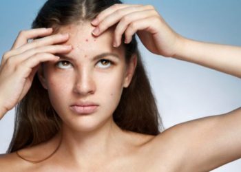 რა საკვები გვეხმარება აკნეს მოშორებაში