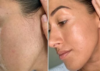 როგორ მოვიცილოთ სახიდან არასასურველი თმა ერთხელ და სამუდამოდ?