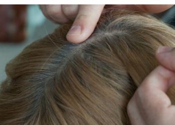 როგორ ავიცილოთ თავიდან ჭაღარა?