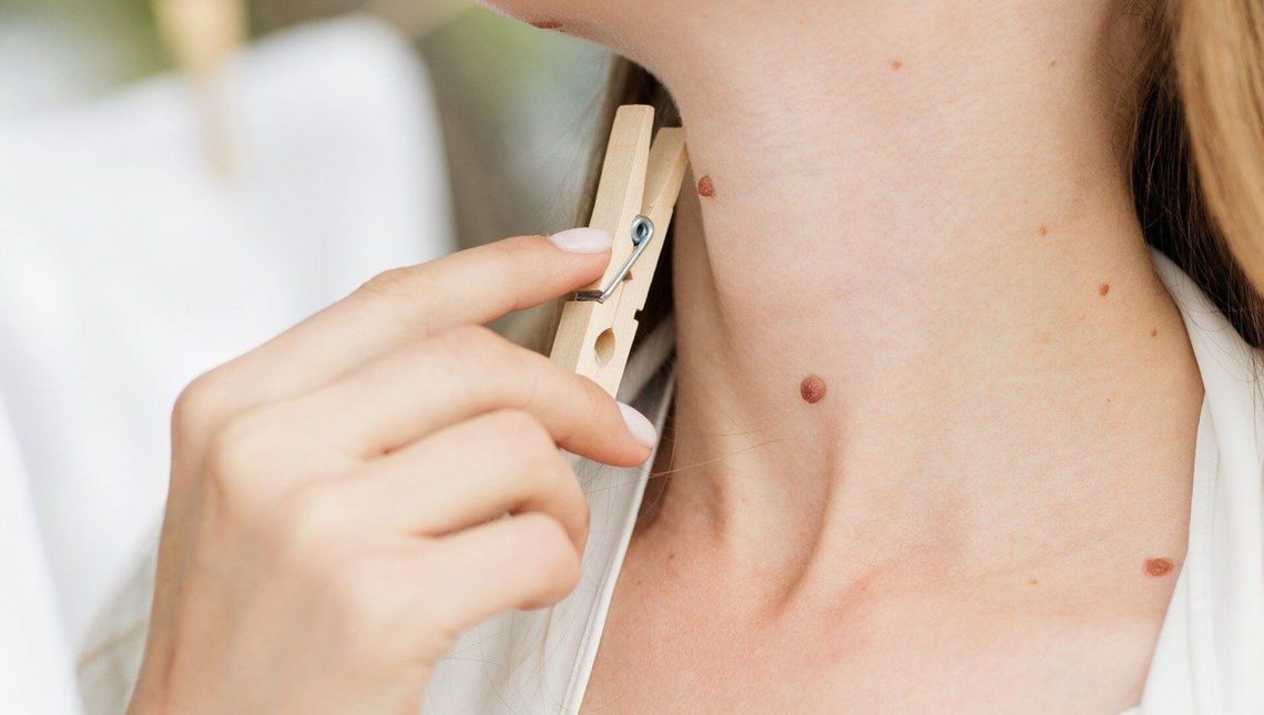 ის გეტყვით ყველაფერს თქვენს ბედზე – ნახეთ რას ნიშნავს თითოეული ხალი თქვენს სხეულზე