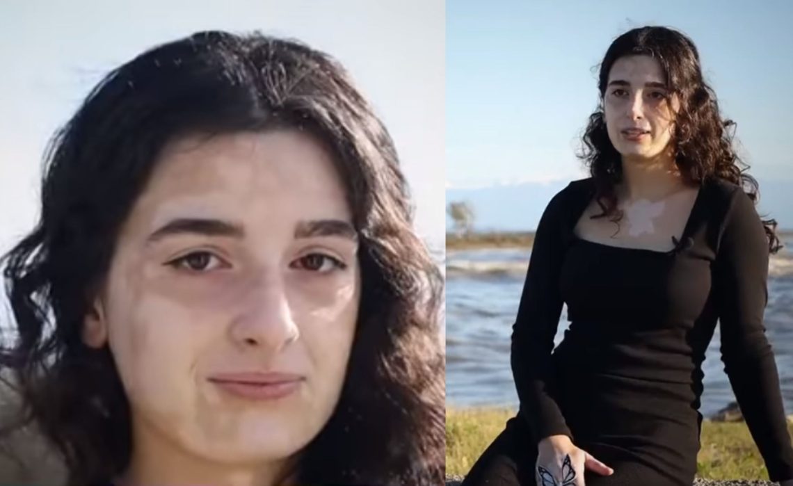 🎥 გაიცანით მარიამ ჭაჭუა, კოპლებიანი გოგონა – როგორია ცხოვრება ვიტილიგოს დიაგნოზით