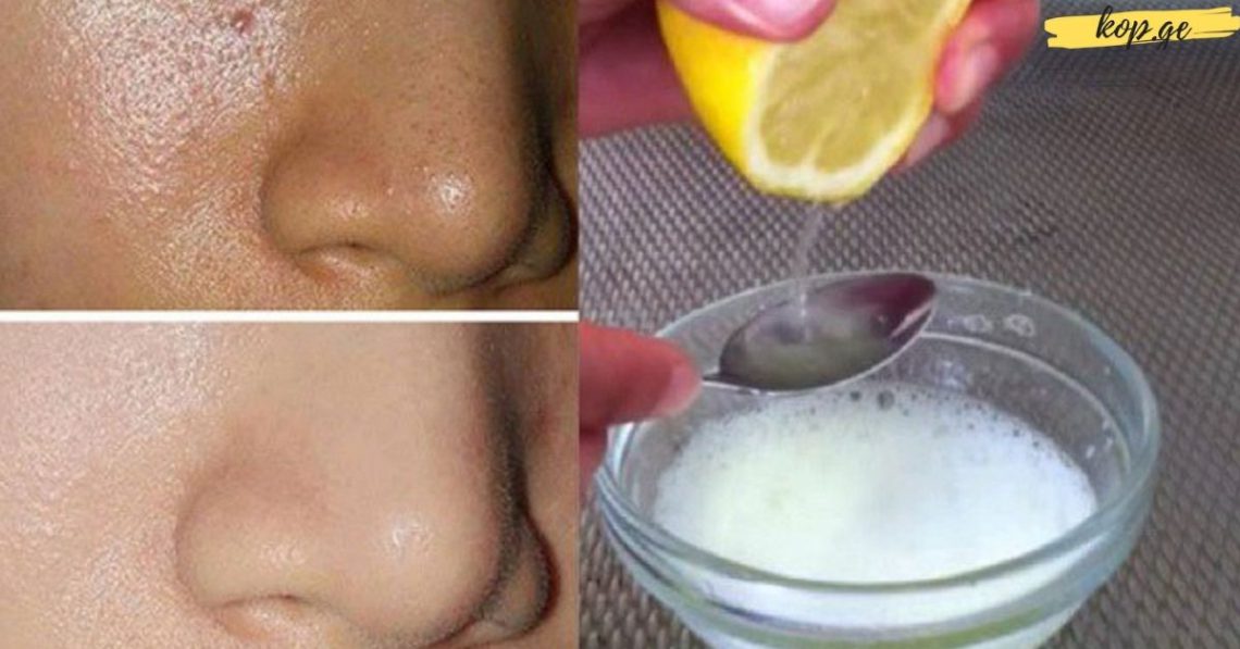 “თუ ამ ნიღბებს გამოიყენებთ, ნაოჭები და პიგმენტური ლაქები რამდენიმე დღეში ნაკლებად შესამჩნევი გახდება