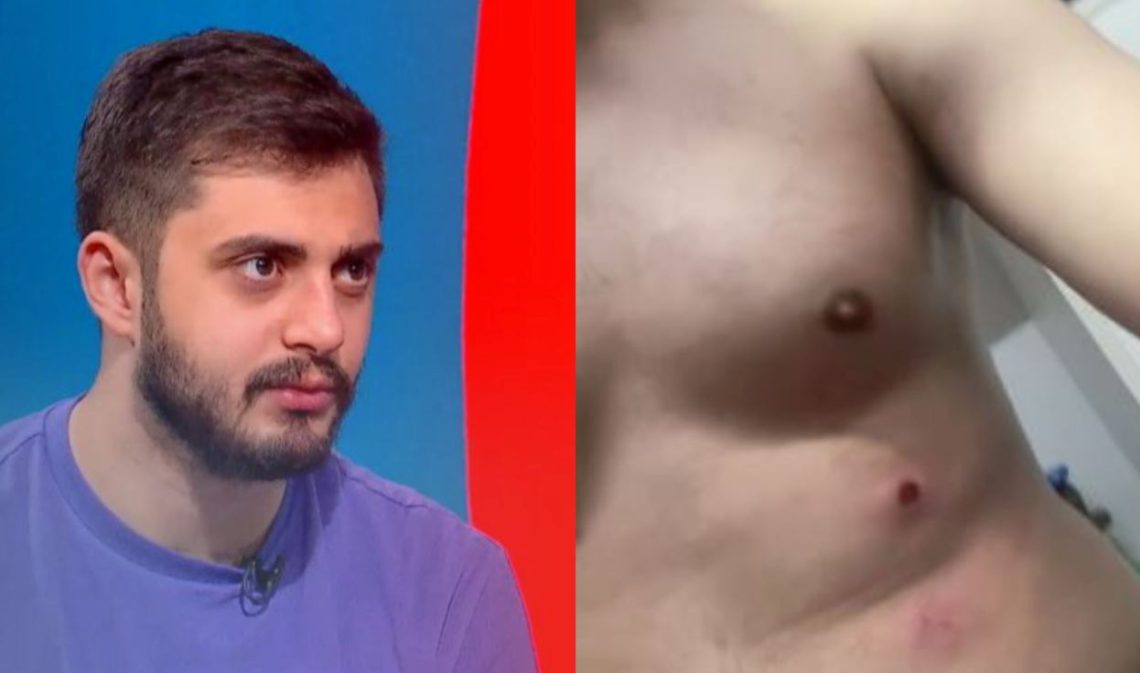 🎥სპეცრაზმი ცოტნე კობერიძეს რეზინის ტყვიებით გაუსწორდა – როგორია მისი მდგომარეობა?