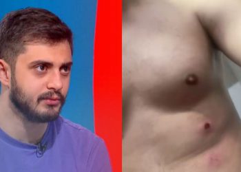 🎥სპეცრაზმი ცოტნე კობერიძეს რეზინის ტყვიებით გაუსწორდა – როგორია მისი მდგომარეობა?