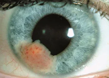 თვალის კიბოს უჩვეულო სიმპტომები