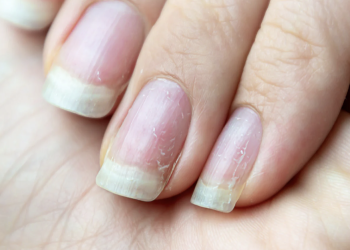 რომელი დაავადებების სიმპტომია ფრჩხილების მტვრევა