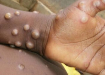 არსებობს თუ არა “მაიმუნის ყვავილის” საქართველოში გავრცელების რისკი და რა სიმპტომები ახასიათებს ინფექციას – სპეციალისტების პროგნოზი