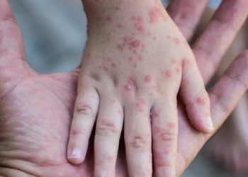 რა არის “მაიმუნის ყვავილი”, რა სიმპტომები ასახიათებს და როგორ ხდება მისი მკურნალობა