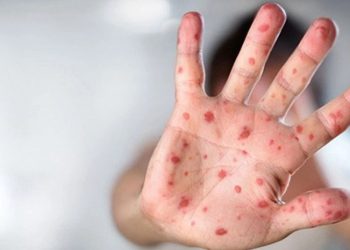 “მაღალი ცხელება და ძალიან უცნაური გამონაყარი ხელისა ფეხის გულებზე…” – ეპიდემიოლოგები მოსახლეობას აფრთხილებენ