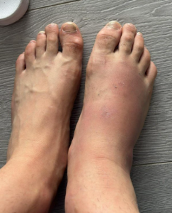 „ეს რა დამართეს ფეხზე?“ – ნახეთ, ხვიჩა კვარაცხელიას ტრავმის ამსახველმა ფოტო