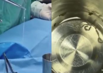 “მითხრეს რომ სიმსივნის მე-4 სტადია მქონდა” – ქართველი ექიმი, პაციენტის თავის ტვინიდან 15 სმ-იანი ცოცხალი ჭიის ამოყვანის კადრებს ავრცელებს