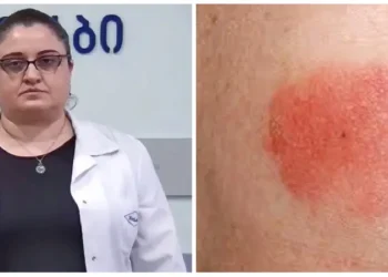 როგორია ტკიპების ნაკბენით გამოწვეული ინფექციის სიმპტომები და როგორ უნდა დავიცვათ თავი – ინფექციონისტის რჩევები