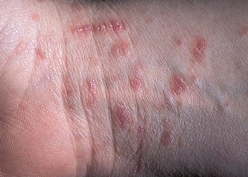 მუნით ინფიცირების შემთხვევები სკოლაში – რა უნდა ვიცოდეთ?