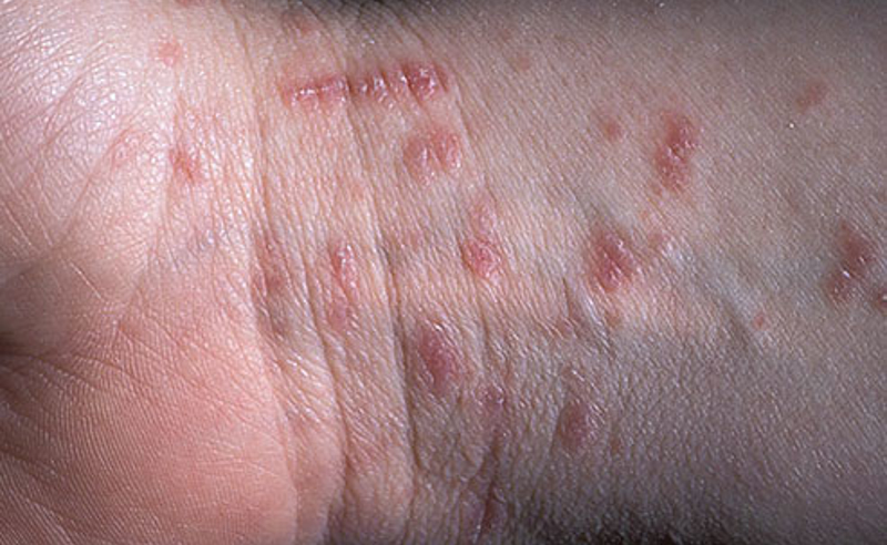 მუნით ინფიცირების შემთხვევები სკოლაში – რა უნდა ვიცოდეთ?