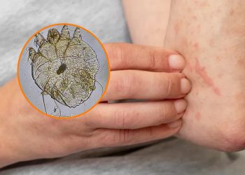 ქუთაისის საჯარო სკოლებში მუნის შემთხვევები დაფიქსირდა