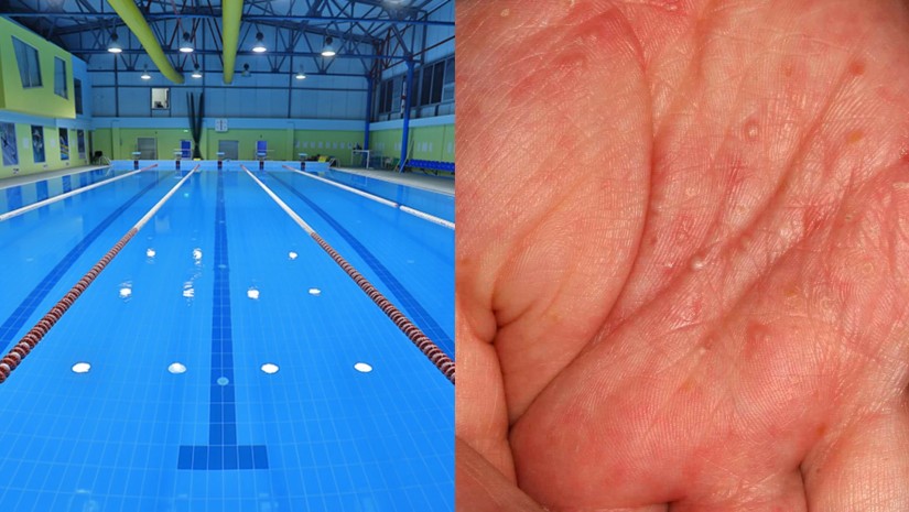 როგორია მუნის გადადების რისკი აუზიდან – ინფექციონისტის განმარტება