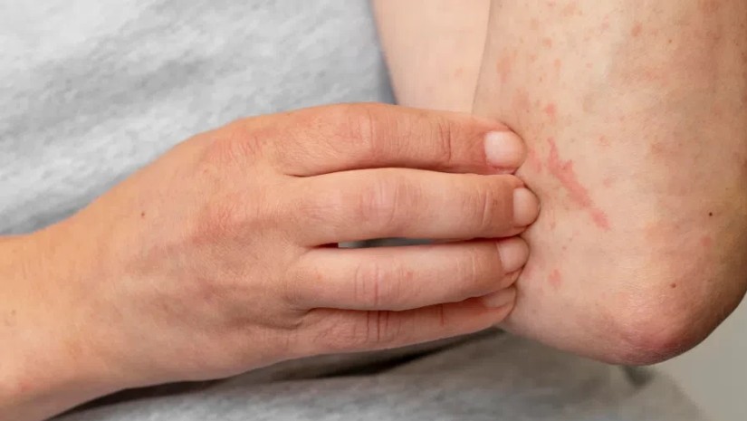 როგორ ვრცელდება მუნი? – რა უნდა ვიცოდეთ ამ დაავადების შესახებ