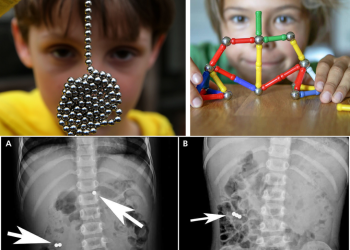 ერთი შეხედვით უწყინარი სათამაშო, რომელმაც შეიძლება ბავშვის სიცოცხლე საფრთხეში ჩააგდოს – ექიმების საგანგაშო გაფრთხილება